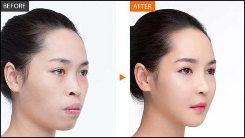 Quảng cáo dạng Before - After cũng không được phép đăng tải